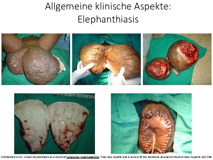 Allgemeine klinische Aspekte: Elephanthiasis Chintamani et al. : Vulval elephantiasis as a result of