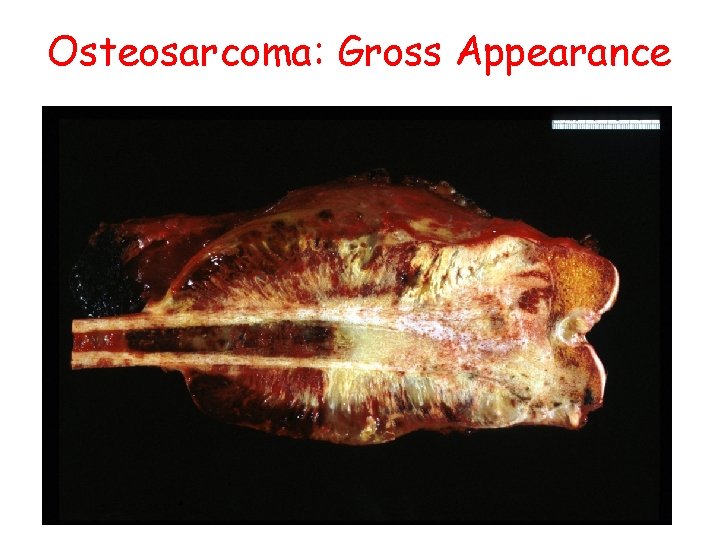 Osteosarcoma: Gross Appearance 