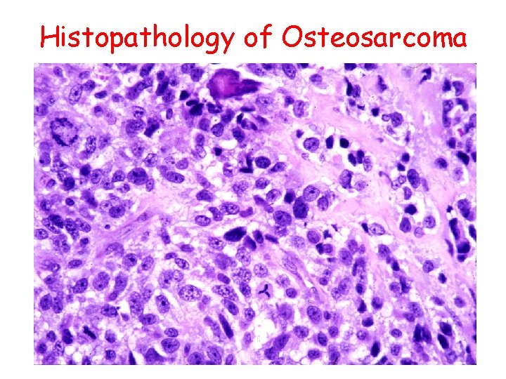 Histopathology of Osteosarcoma 