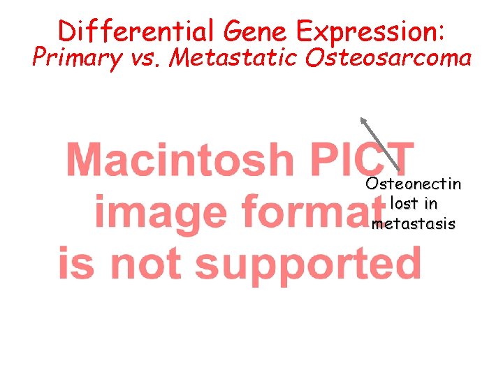 Differential Gene Expression: Primary vs. Metastatic Osteosarcoma Osteonectin lost in metastasis 