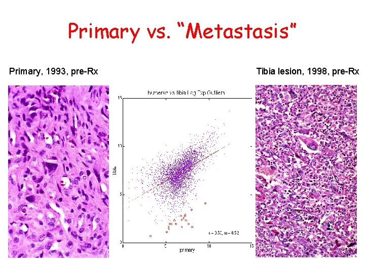 Primary vs. “Metastasis” Primary, 1993, pre-Rx Tibia lesion, 1998, pre-Rx 