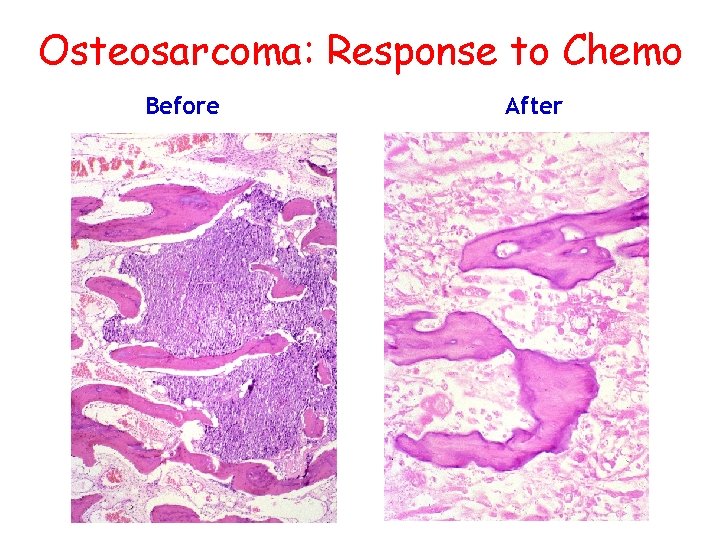 Osteosarcoma: Response to Chemo Before After 
