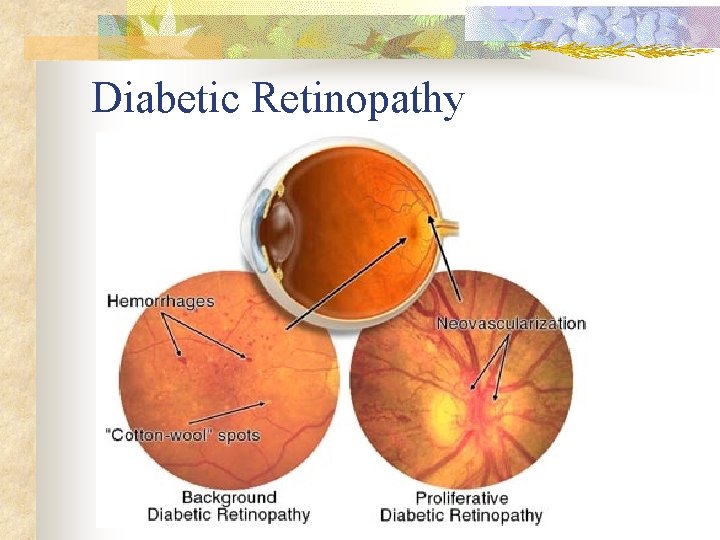 Diabetic Retinopathy 