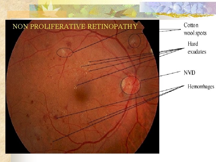 NON PROLIFERATIVE RETINOPATHY 