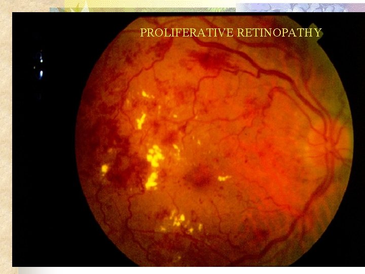 PROLIFERATIVE RETINOPATHY 