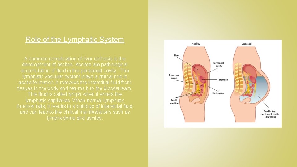 Role of the Lymphatic System A common complication of liver cirrhosis is the development