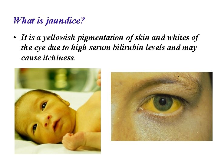 What is jaundice? • It is a yellowish pigmentation of skin and whites of