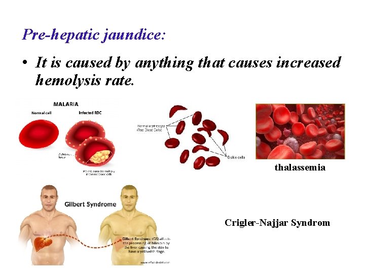 Pre-hepatic jaundice: • It is caused by anything that causes increased hemolysis rate. thalassemia