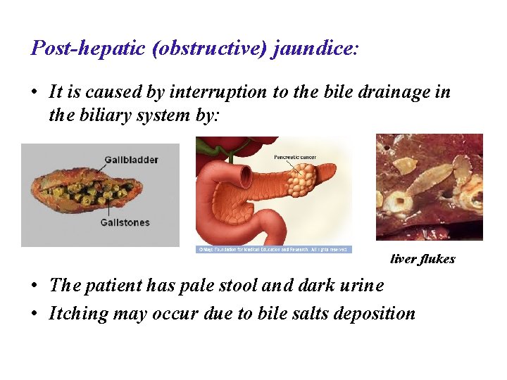 Post-hepatic (obstructive) jaundice: • It is caused by interruption to the bile drainage in