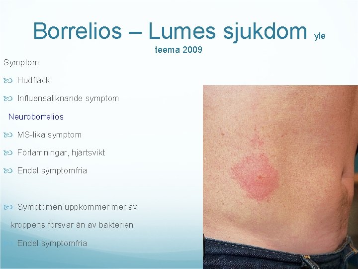 Borrelios – Lumes sjukdom teema 2009 Symptom Hudfläck Influensaliknande symptom Neuroborrelios MS-lika symptom Förlamningar,