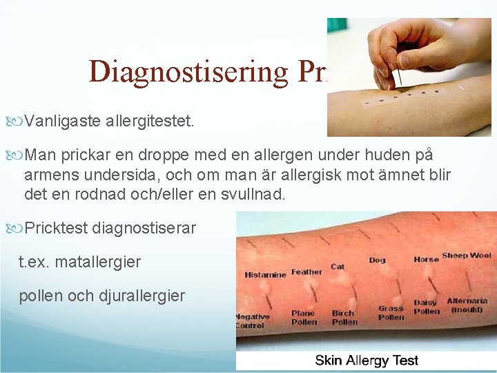 Diagnostisering Pricktest Vanligaste allergitestet. Man prickar en droppe med en allergen under huden på