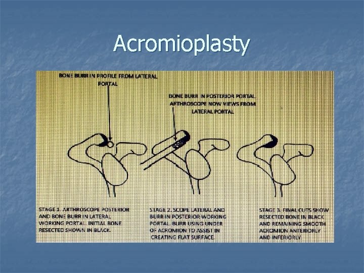 Acromioplasty 