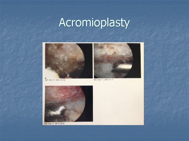 Acromioplasty 