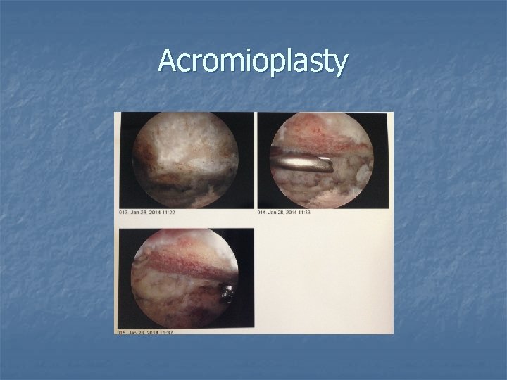 Acromioplasty 