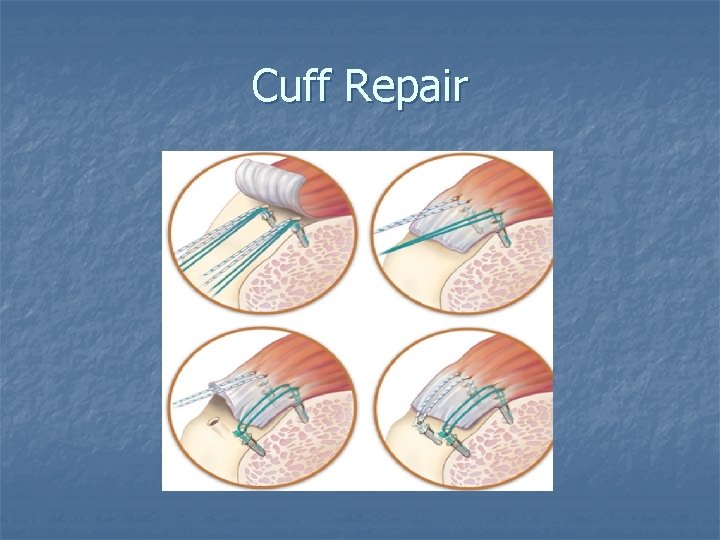 Cuff Repair 