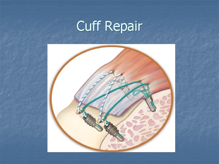 Cuff Repair 