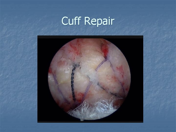 Cuff Repair 