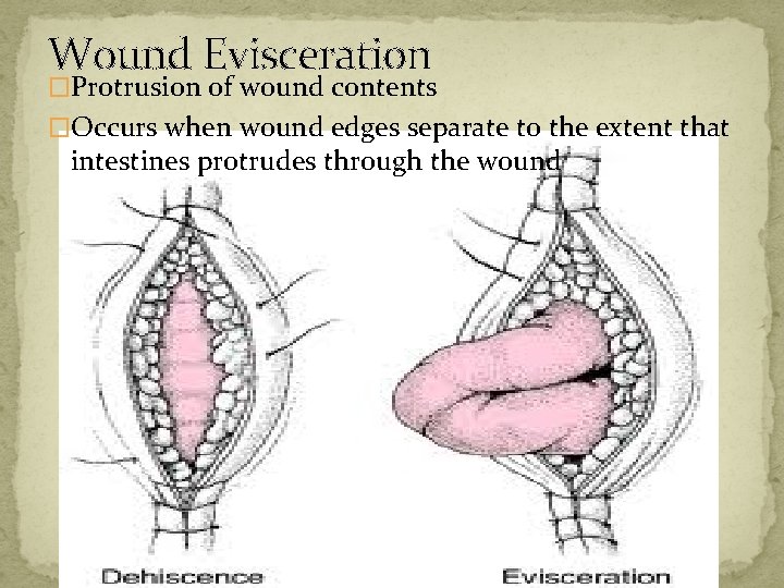 Wound Evisceration �Protrusion of wound contents �Occurs when wound edges separate to the extent