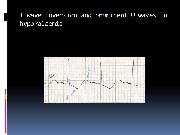 T wave inversion and prominent U waves in hypokalaemia 