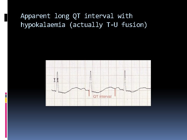 Apparent long QT interval with hypokalaemia (actually T-U fusion) 