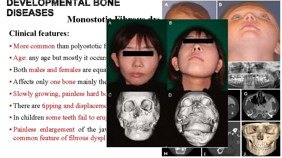 Monostotic Fibrous dysplasia of bone Clinical features: § More common than polyostotic fibrous dysplasia