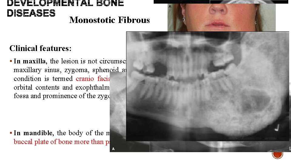 Monostotic Fibrous dysplasia of bone Clinical features: § In maxilla, the lesion is not