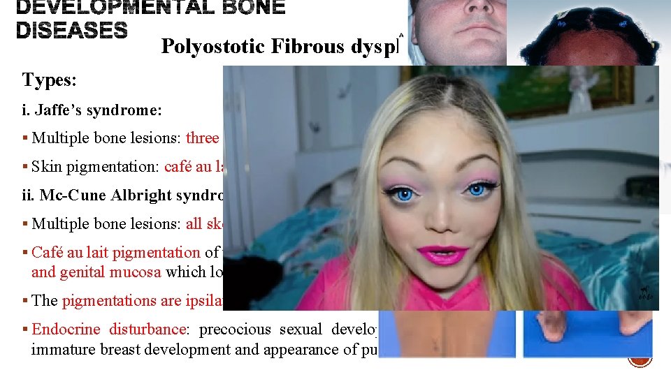 Polyostotic Fibrous dysplasia of bone Types: i. Jaffe’s syndrome: § Multiple bone lesions: three