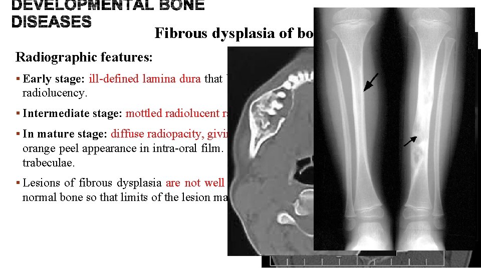 Fibrous dysplasia of bone Radiographic features: § Early stage: ill-defined lamina dura that blends