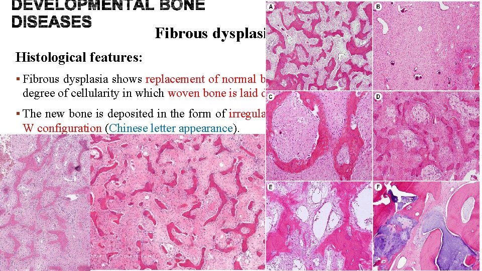 Fibrous dysplasia of bone Histological features: § Fibrous dysplasia shows replacement of normal bone