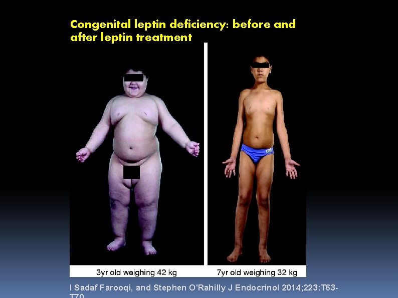 Congenital leptin deficiency: before and after leptin treatment I Sadaf Farooqi, and Stephen O'Rahilly