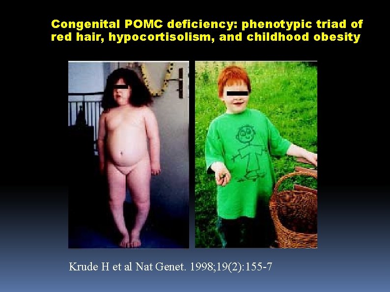 Congenital POMC deficiency: phenotypic triad of red hair, hypocortisolism, and childhood obesity Krude H