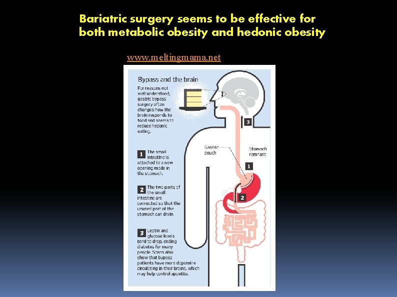 Bariatric surgery seems to be effective for both metabolic obesity and hedonic obesity www.