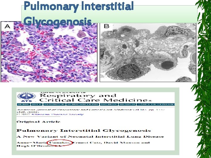 Pulmonary Interstitial Glycogenosis 