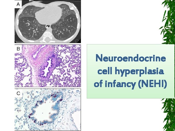 Neuroendocrine cell hyperplasia of infancy (NEHI) 