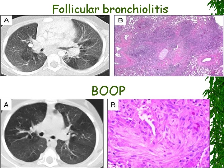 Follicular bronchiolitis BOOP 