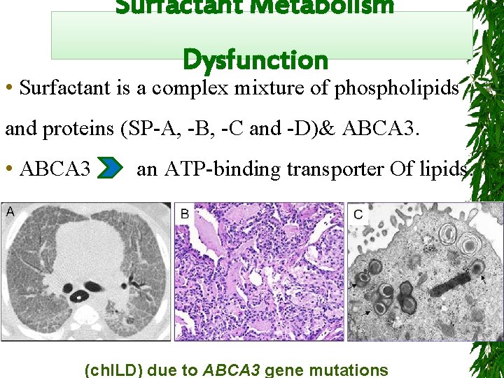 Surfactant Metabolism Dysfunction • Surfactant is a complex mixture of phospholipids and proteins (SP-A,