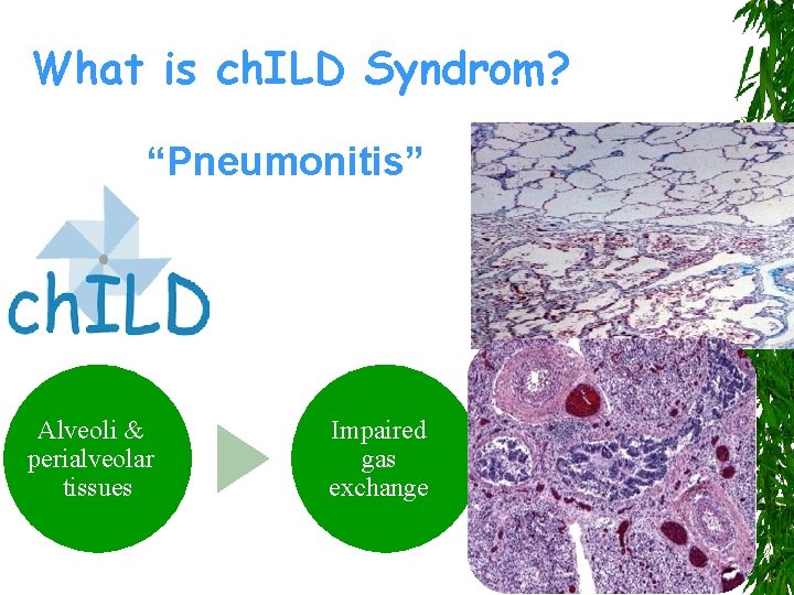 What is ch. ILD Syndrom? “Pneumonitis” Alveoli & perialveolar tissues Impaired gas exchange 