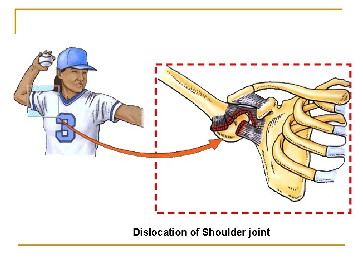 Dislocation of Shoulder joint 