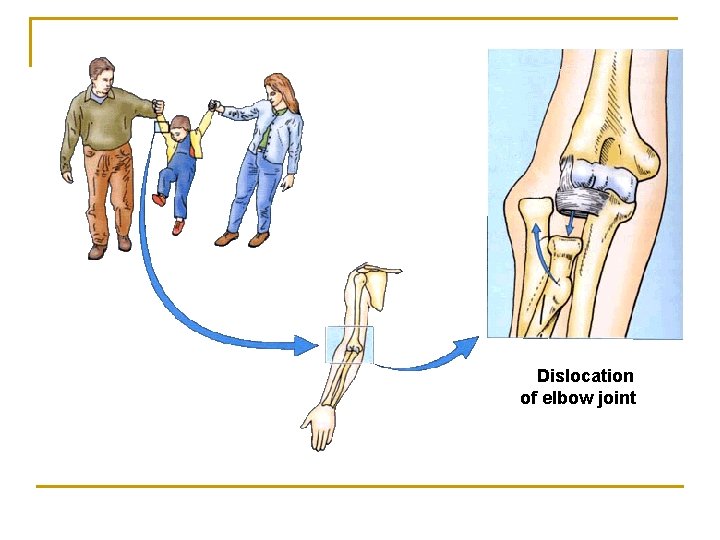 Dislocation of elbow joint 