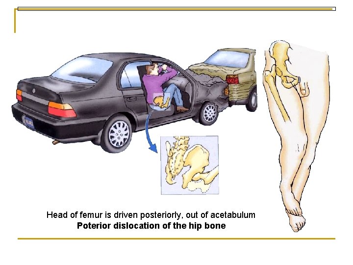 Head of femur is driven posteriorly, out of acetabulum Poterior dislocation of the hip