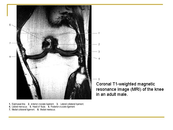 Coronal T 1 -weighted magnetic resonance image (MRI) of the knee in an adult
