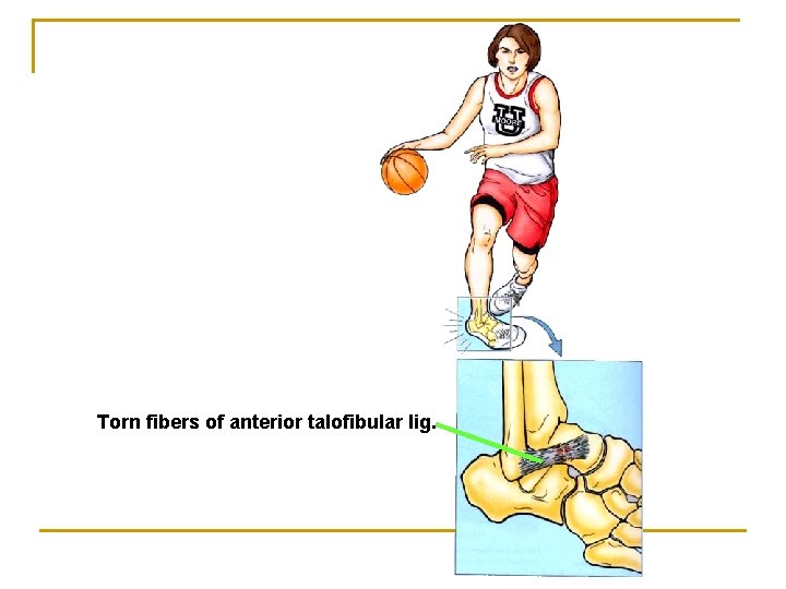 Torn fibers of anterior talofibular lig. 