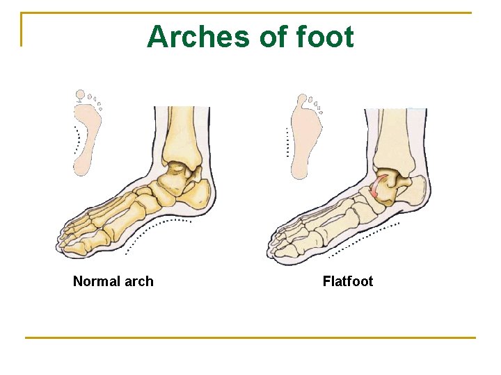 Arches of foot Normal arch Flatfoot 