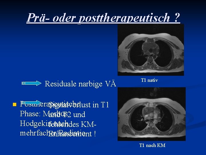 Prä- oder posttherapeutisch ? Residuale narbige VÄ n T 1 nativ Posttherapeutische Signalverlust in