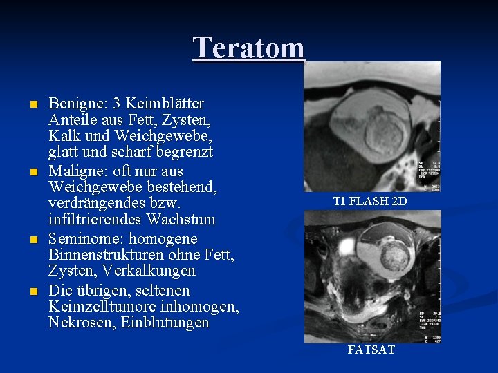 Teratom n n Benigne: 3 Keimblätter Anteile aus Fett, Zysten, Kalk und Weichgewebe, glatt