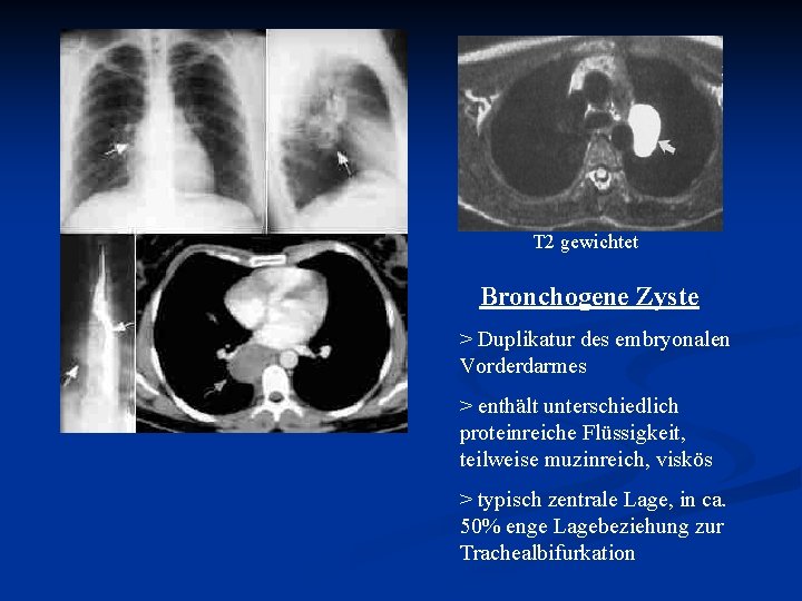 T 2 gewichtet Bronchogene Zyste > Duplikatur des embryonalen Vorderdarmes > enthält unterschiedlich proteinreiche