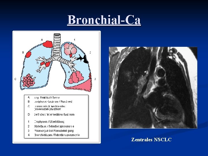 Bronchial-Ca Zentrales NSCLC 