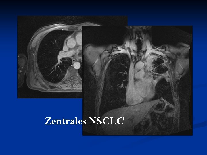 Zentrales NSCLC 