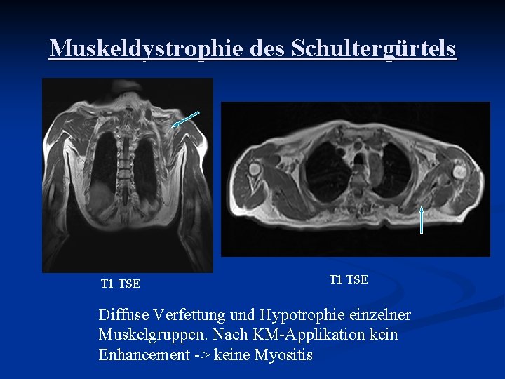 Muskeldystrophie des Schultergürtels T 1 TSE Diffuse Verfettung und Hypotrophie einzelner Muskelgruppen. Nach KM-Applikation