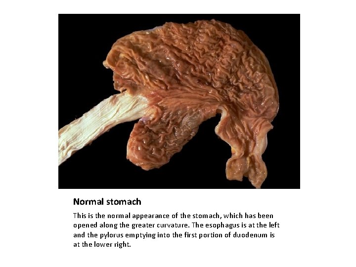 Normal stomach This is the normal appearance of the stomach, which has been opened
